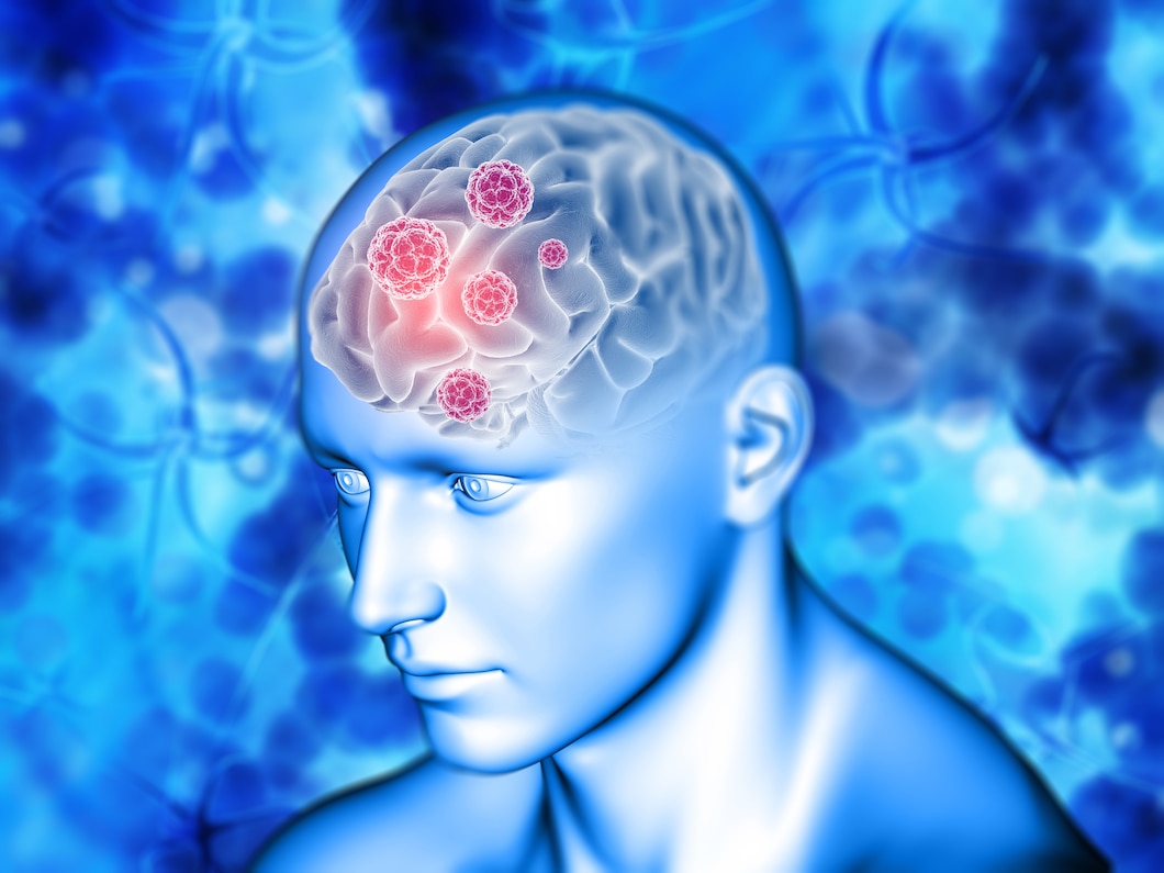 Rozpoznawanie i leczenie powszechnych schorzeń neurologicznych: od migren po stwardnienie rozsiane